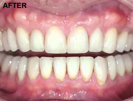 After Fixed Dentures at Impressionz Dental Care