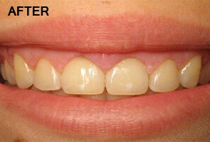 After Gingivectomy Procedure at Impressionz Dental Care
