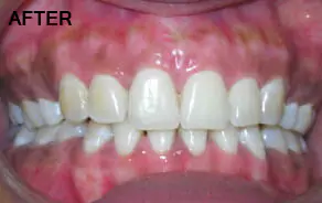 After Gum Depigmentation at Impressionz Dental Care