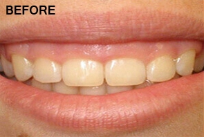 Before Gingivectomy Procedure