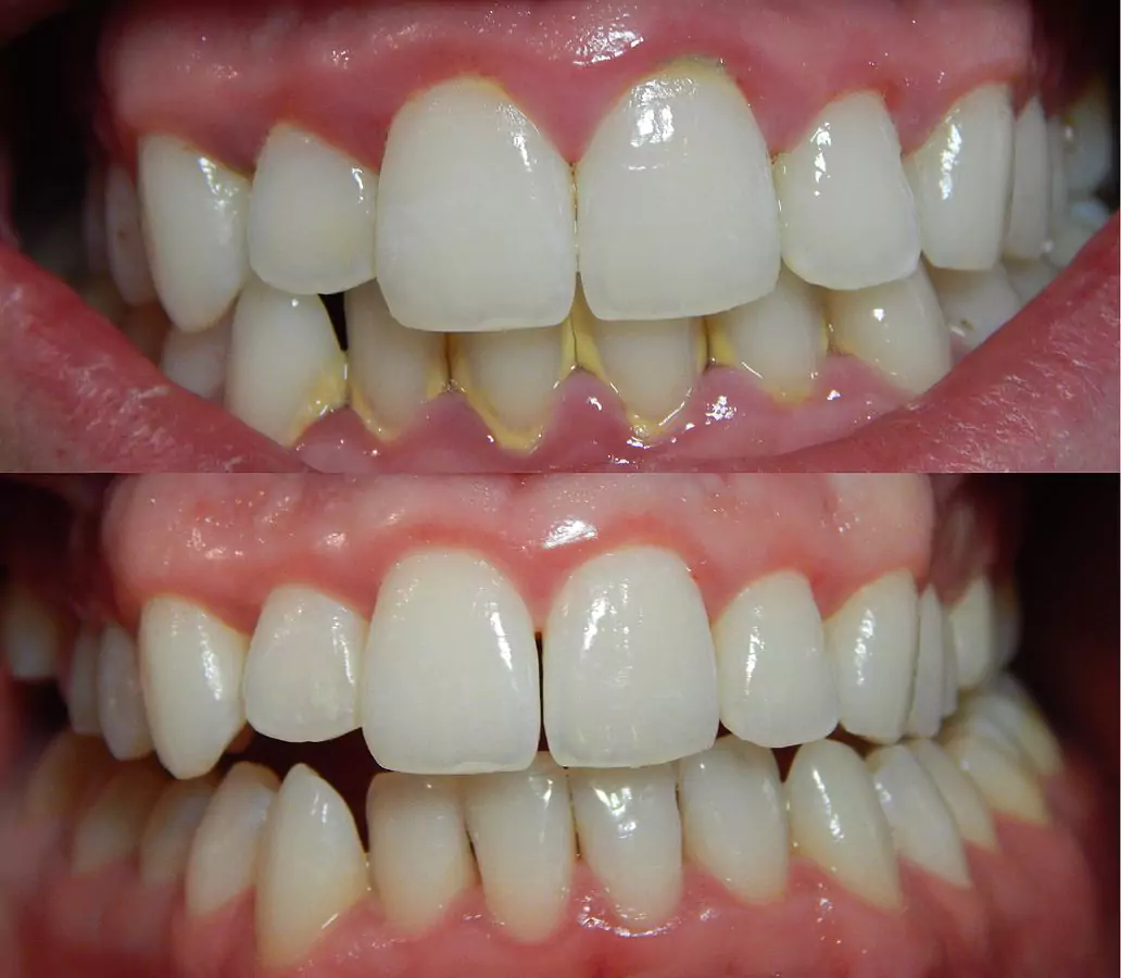 Calculus Teeth and Dental Plaque Removal at Impressionz Dental Care
