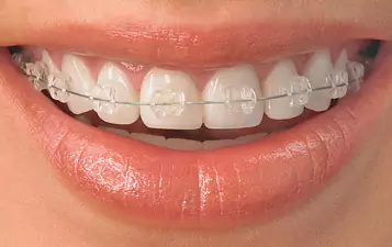 Ceramic Braces at Impressionz Dental Care