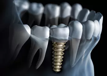 Dental Implant Clinic in Borivali West