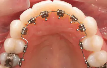 Lingual Dental Braces at Impressionz Dental Care