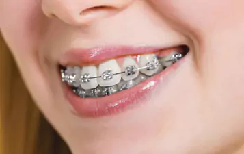 Metal Braces at Impressionz Dental Care