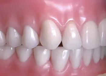 Oral Rehabilitations at Impressionz Dental Care