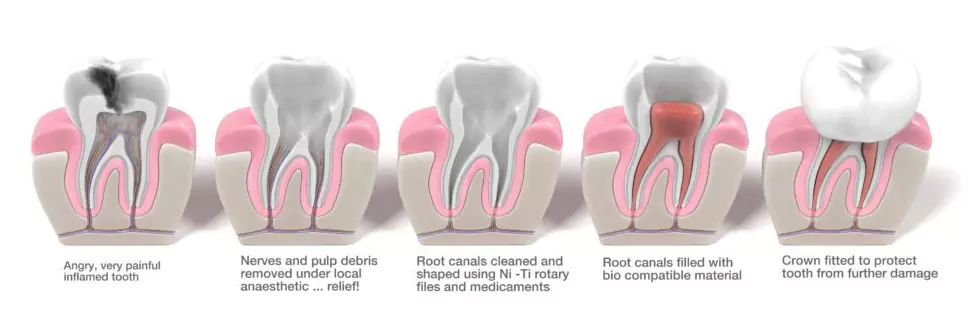 Root Canal Treatment in Borivali West