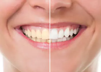 Teeth Whitening and Bleaching Services in Borivali West