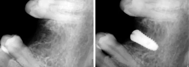 Dental Implants X Ray at Impressionz Dental Care