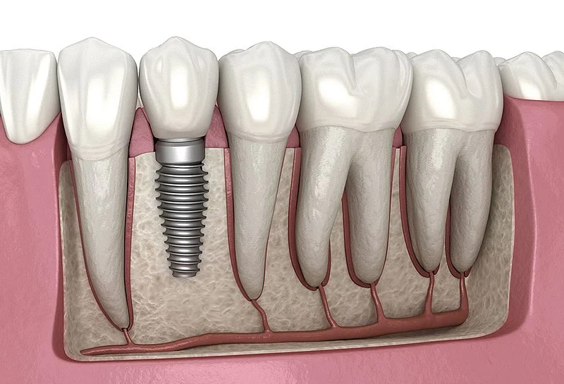 Dental Implants in Mumbai