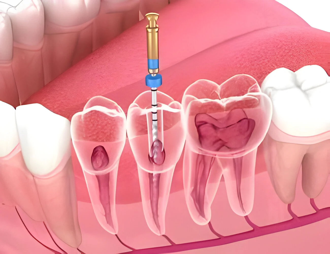 RCT Teeth Treatment in Mumbai