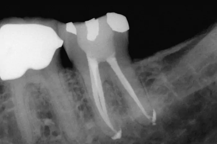 Root Canal X Ray