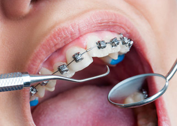 orthodontics-braces