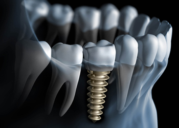 dental implants in andheri,mumbai