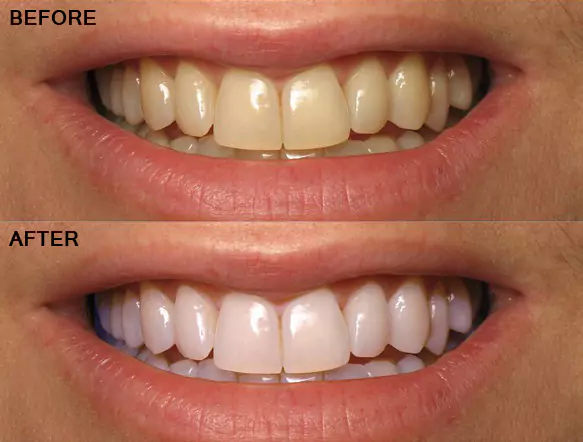 Teeth Whitening Services at Impressionz Dental Care