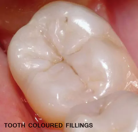 Tooth Colored Composite Dental Fillings at Impressionz Dental Care