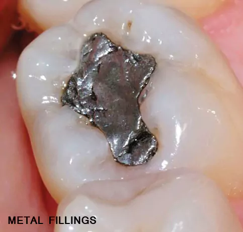 Dental Tooth Metal Fillings at Impressionz Dental Care